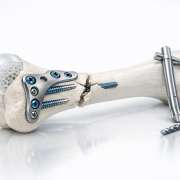 Managing Pathologic Fractures: An Informative Guide