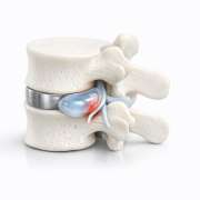f3fd66e9-herniated-disc-causes-symptoms-and-treatment.png Herniated Disc: Causes, Symptoms, and Treatment