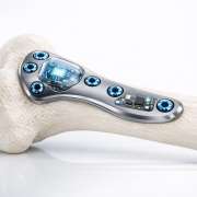 The Future of Fixation: Will Smart Implants Replace Traditional Plates?