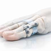 A Comprehensive Guide to Hallux Valgus Deformity Correction