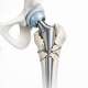 Understanding the Vancouver Classification for Periprosthetic Hip Fractures