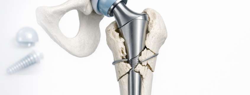 Understanding the Vancouver Classification for Periprosthetic Hip Fractures