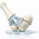 Understanding the Eaton-Glickel Classification for CMC Osteoarthritis