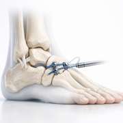 The Unstable Ankle: When Does a “Sprain” Require a Surgical Strategy?