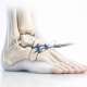 The Unstable Ankle: When Does a “Sprain” Require a Surgical Strategy?