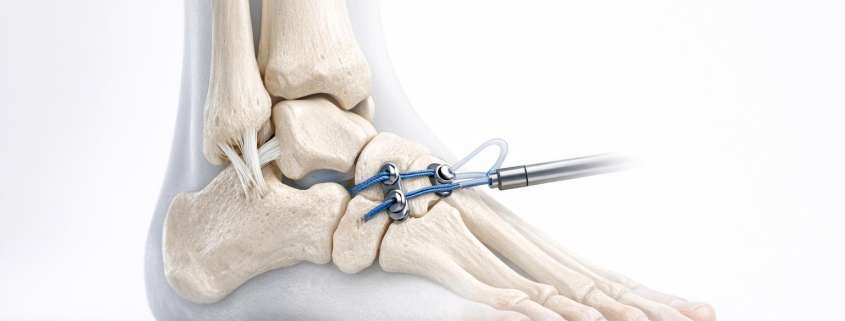The Unstable Ankle: When Does a “Sprain” Require a Surgical Strategy?