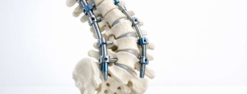 Why Surgeon Volume Matters for Complex Spinal Deformity Outcomes