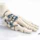 A Comprehensive Guide to Midfoot Arthrodesis Techniques
