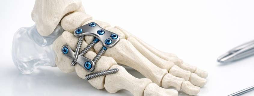 A Comprehensive Guide to Midfoot Arthrodesis Techniques