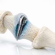 Bio-Integrative Implants: The Next Frontier in ACL Reconstruction