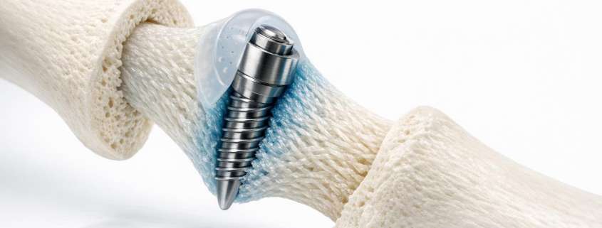 Bio-Integrative Implants: The Next Frontier in ACL Reconstruction