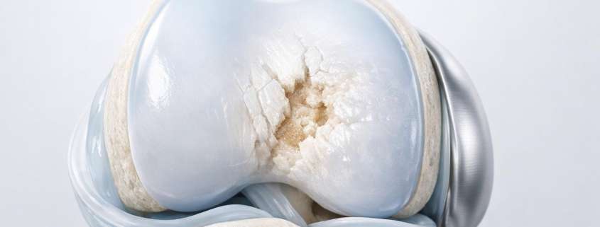 Understanding the Outerbridge Classification of Articular Cartilage Lesions