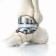 Current Concepts in Total Ankle Arthroplasty