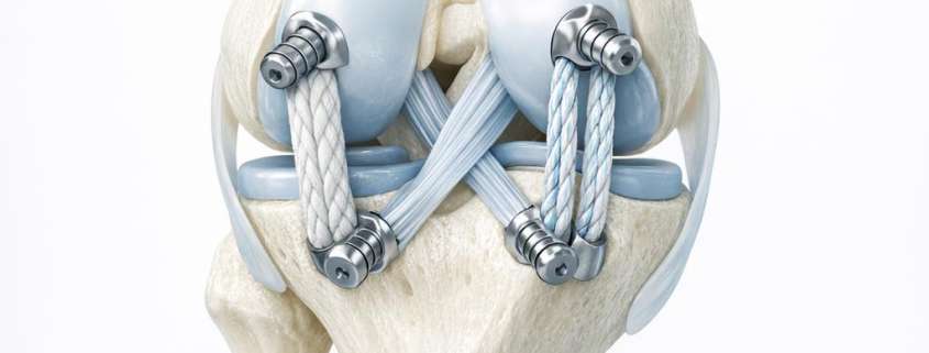 A Review of PCL Reconstruction: Single-Bundle vs. Double-Bundle Techniques