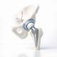 Lessons from Longitudinal Studies on Hip Replacements in Patients Under 30
