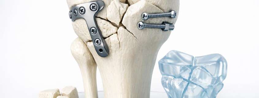 Understanding the Schatzker Classification of Tibial Plateau Fractures