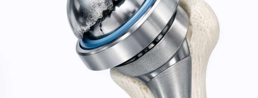 Lessons from the Failures of Early Metal-on-Metal Shoulder Bearings