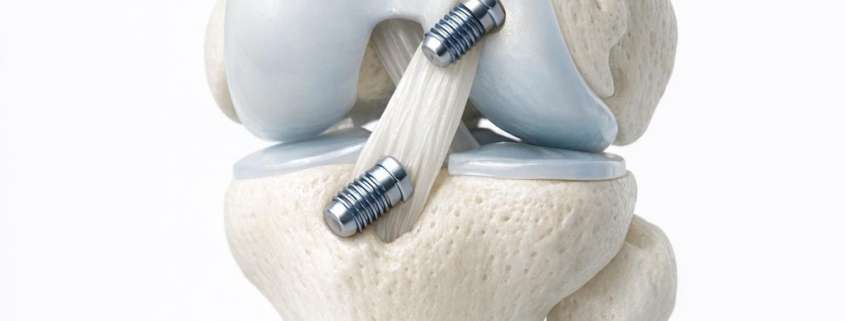 Current Concepts in the Treatment of Pediatric Anterior Cruciate Ligament (ACL) Tears