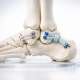 Management of Chronic Lateral Ankle Instability: Broström vs. Augmentation